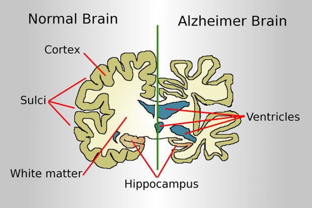 Imagen de un cerebro normal (izquierda) y de uno afectado por Alzheimer (derecha). En zonas rurales, el tratamiento contra esta grave enfermedad mental enfrenta serios desafíos. Imagen cortesía de The Commons